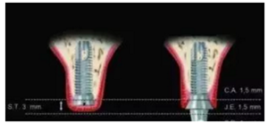 美學種植治療---軟組織的處理 美學種植治療---軟組織的處理
