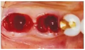 美學種植治療---軟組織的處理 美學種植治療---軟組織的處理