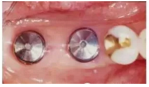 美學種植治療---軟組織的處理 美學種植治療---軟組織的處理