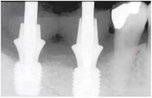 美學種植治療---軟組織的處理 美學種植治療---軟組織的處理