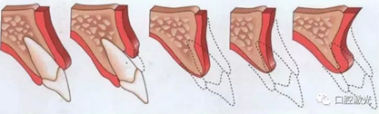 激光輔助牙槽嵴保存技術(shù) 激光輔助牙槽嵴保存技術(shù)