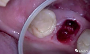 激光輔助牙槽嵴保存技術(shù) 激光輔助牙槽嵴保存技術(shù)