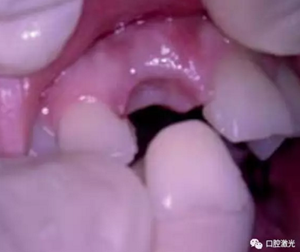 激光輔助牙槽嵴保存技術(shù) 激光輔助牙槽嵴保存技術(shù)