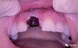 激光輔助牙槽嵴保存技術(shù) 激光輔助牙槽嵴保存技術(shù)