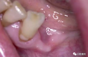 激光輔助牙槽嵴保存技術(shù) 激光輔助牙槽嵴保存技術(shù)