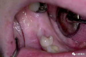 激光輔助牙槽嵴保存技術(shù) 激光輔助牙槽嵴保存技術(shù)