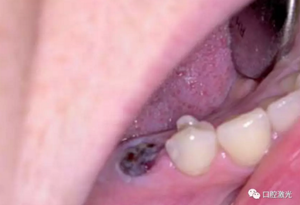 激光輔助牙槽嵴保存技術(shù) 激光輔助牙槽嵴保存技術(shù)