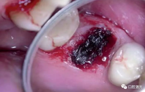 激光輔助牙槽嵴保存技術(shù) 激光輔助牙槽嵴保存技術(shù)