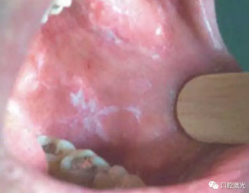 半導(dǎo)體激光軟組織焊接治療糜爛型扁平苔蘚 半導(dǎo)體激光軟組織焊接治療糜爛型扁平苔蘚