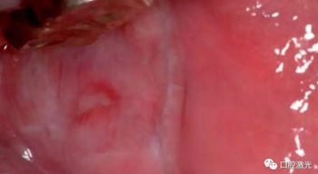 半導(dǎo)體激光軟組織焊接治療糜爛型扁平苔蘚 半導(dǎo)體激光軟組織焊接治療糜爛型扁平苔蘚