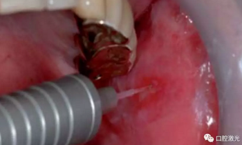 半導(dǎo)體激光軟組織焊接治療糜爛型扁平苔蘚 半導(dǎo)體激光軟組織焊接治療糜爛型扁平苔蘚