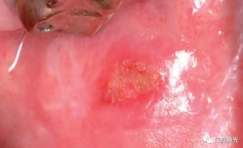 半導(dǎo)體激光軟組織焊接治療糜爛型扁平苔蘚 半導(dǎo)體激光軟組織焊接治療糜爛型扁平苔蘚