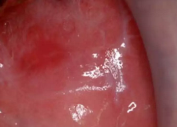 半導(dǎo)體激光軟組織焊接治療糜爛型扁平苔蘚 半導(dǎo)體激光軟組織焊接治療糜爛型扁平苔蘚