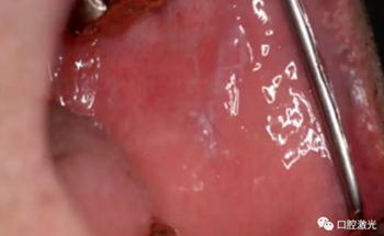 半導(dǎo)體激光軟組織焊接治療糜爛型扁平苔蘚 半導(dǎo)體激光軟組織焊接治療糜爛型扁平苔蘚