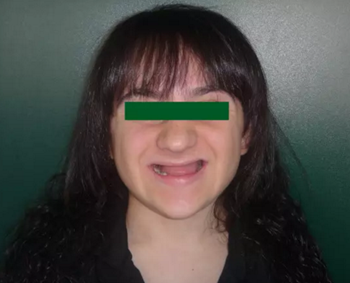 病例討論:釉質(zhì)發(fā)育不全 1 例 病例討論:釉質(zhì)發(fā)育不全 1 例