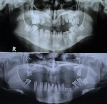 病例討論:釉質(zhì)發(fā)育不全 1 例 病例討論:釉質(zhì)發(fā)育不全 1 例