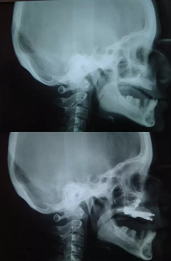 病例討論:釉質(zhì)發(fā)育不全 1 例 病例討論:釉質(zhì)發(fā)育不全 1 例