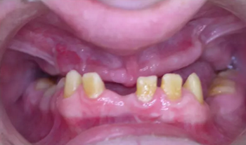 病例討論:釉質(zhì)發(fā)育不全 1 例 病例討論:釉質(zhì)發(fā)育不全 1 例