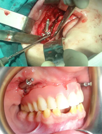 病例討論:釉質(zhì)發(fā)育不全 1 例 病例討論:釉質(zhì)發(fā)育不全 1 例