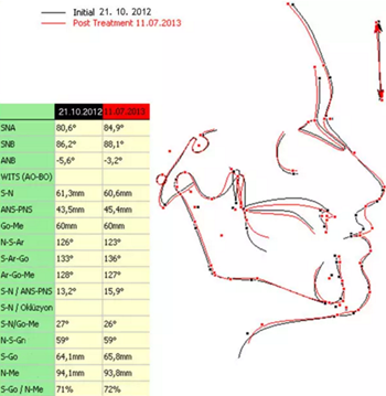 病例討論:釉質(zhì)發(fā)育不全 1 例 病例討論:釉質(zhì)發(fā)育不全 1 例