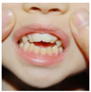 窩溝封閉 窩溝封閉