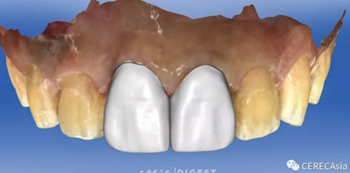 擁有瓷塊選擇權，是負擔還是自由？