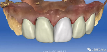 擁有瓷塊選擇權，是負擔還是自由？
