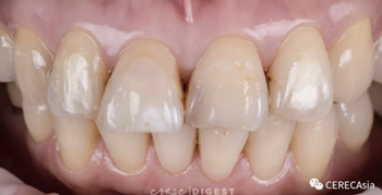 擁有瓷塊選擇權，是負擔還是自由？