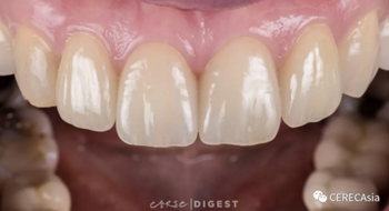 擁有瓷塊選擇權，是負擔還是自由？