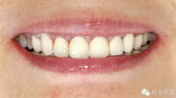 固定修復(fù)中的咬合問題與處理原則 固定修復(fù)中的咬合問題與處理原則