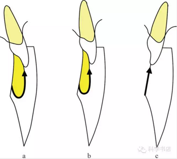 固定修復(fù)中的咬合問題與處理原則 固定修復(fù)中的咬合問題與處理原則