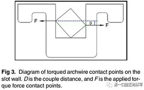 正畸文獻閱讀--不銹鋼托槽與鈦托槽形變差異的有限元分析 正畸文獻閱讀--不銹鋼托槽與鈦托槽形變差異的有限元分析