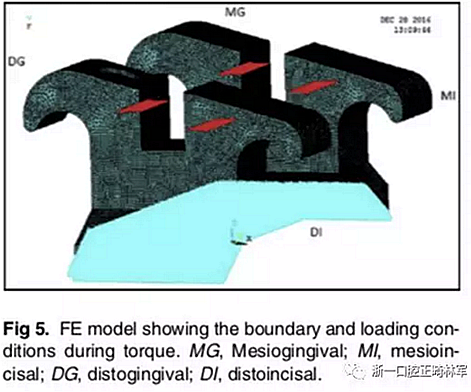 正畸文獻閱讀--不銹鋼托槽與鈦托槽形變差異的有限元分析 正畸文獻閱讀--不銹鋼托槽與鈦托槽形變差異的有限元分析