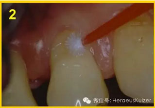 簡單治療——格魯瑪脫敏劑的應(yīng)用 簡單治療——格魯瑪脫敏劑的應(yīng)用