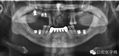 如何在X光片上判斷種植體的品牌 如何在X光片上判斷種植體的品牌