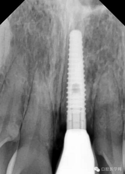如何在X光片上判斷種植體的品牌 如何在X光片上判斷種植體的品牌