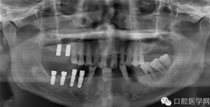 如何在X光片上判斷種植體的品牌 如何在X光片上判斷種植體的品牌