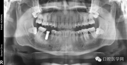 如何在X光片上判斷種植體的品牌 如何在X光片上判斷種植體的品牌