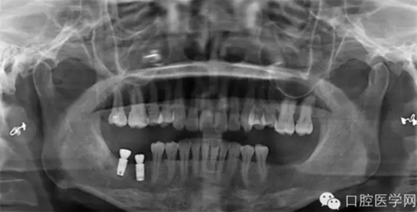 如何在X光片上判斷種植體的品牌 如何在X光片上判斷種植體的品牌