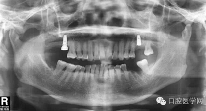 如何在X光片上判斷種植體的品牌 如何在X光片上判斷種植體的品牌