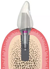 揭秘士卓曼種植體-基臺(tái)的長(zhǎng)期穩(wěn)定性 揭秘士卓曼種植體-基臺(tái)的長(zhǎng)期穩(wěn)定性