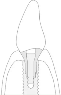 揭秘士卓曼種植體-基臺(tái)的長(zhǎng)期穩(wěn)定性 揭秘士卓曼種植體-基臺(tái)的長(zhǎng)期穩(wěn)定性