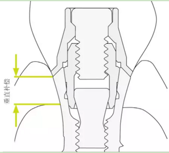 揭秘士卓曼種植體-基臺(tái)的長(zhǎng)期穩(wěn)定性 揭秘士卓曼種植體-基臺(tái)的長(zhǎng)期穩(wěn)定性