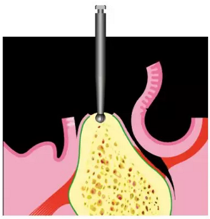 Camlog種植體外科種植小技巧 Camlog種植體外科種植小技巧