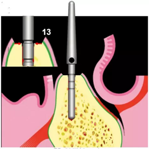 Camlog種植體外科種植小技巧 Camlog種植體外科種植小技巧