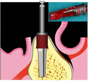 Camlog種植體外科種植小技巧 Camlog種植體外科種植小技巧