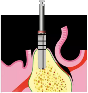 Camlog種植體外科種植小技巧 Camlog種植體外科種植小技巧