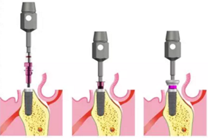 Camlog種植體外科種植小技巧 Camlog種植體外科種植小技巧