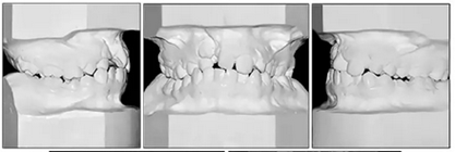 正畸文獻(xiàn)閱讀--單側(cè)唇腭裂患者的多學(xué)科綜合序列治療 正畸文獻(xiàn)閱讀--單側(cè)唇腭裂患者的多學(xué)科綜合序列治療