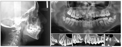 正畸文獻(xiàn)閱讀--單側(cè)唇腭裂患者的多學(xué)科綜合序列治療 正畸文獻(xiàn)閱讀--單側(cè)唇腭裂患者的多學(xué)科綜合序列治療